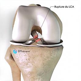 La rupture du LCA (Ligament croisé antérieur) une blessure fréquente dans le sport