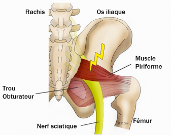 Prise en charge de la sciatique en ostéopathie musculo-squelettique